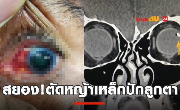 อุทาหรณ์! ตัดหญ้าเศษเหล็กกระเด็นปักลูกตา (18+มีภาพน่ากลัว)